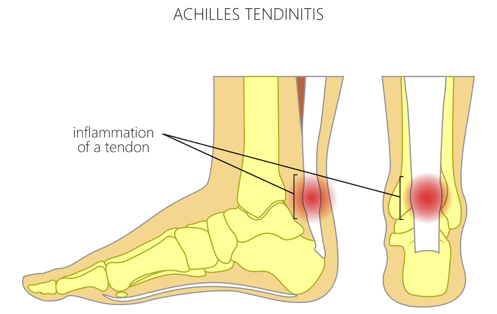 patient's foot diagram about Achilles Tendinitis
